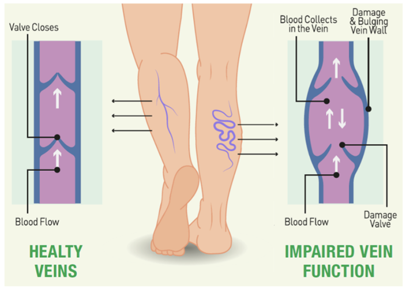 Leg vein health overview: new white paper on Microsmin Plus, the next generation diosmin